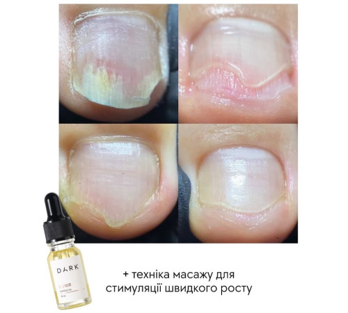 DARK Oil onycholysis oil, 3 ml